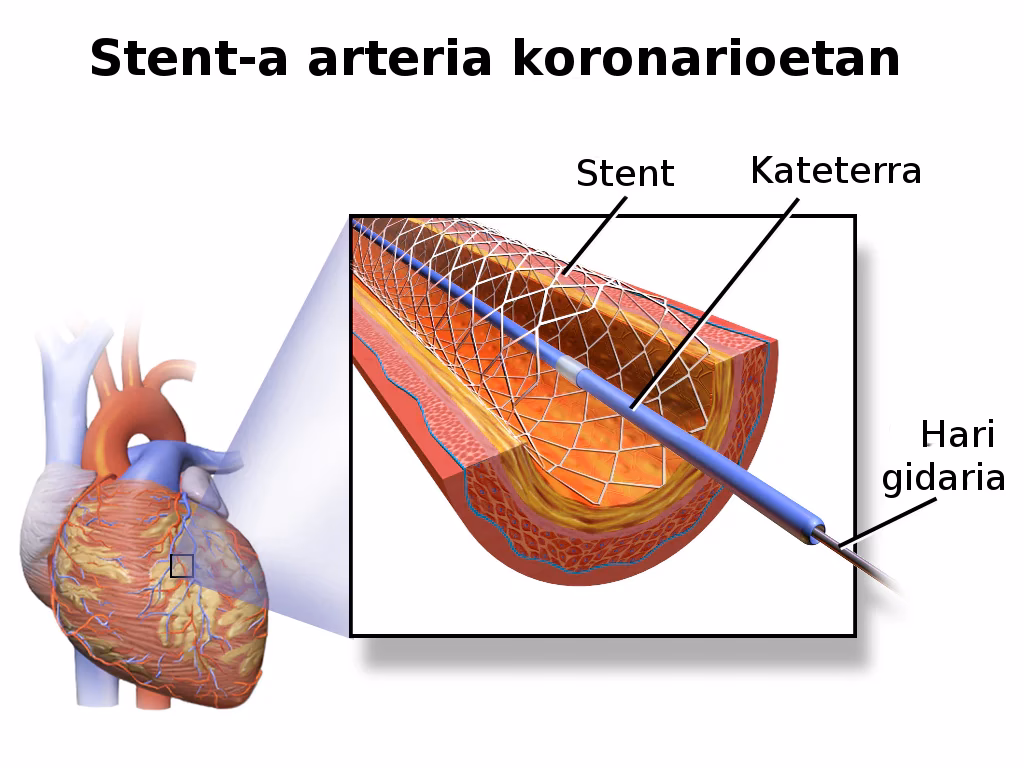 ¿Cuál es la diferencia entre cateterismo y angioplastia?