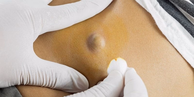 ¿Cómo quitar un absceso de grasa en la ingle?