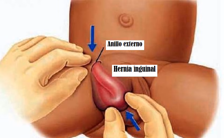 ¿Cuándo hay que preocuparse por un ganglio inflamado en la ingle?