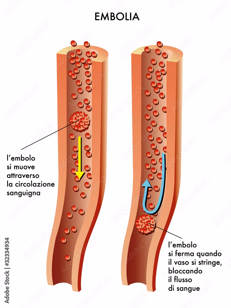 ¿Qué significa tener embolia?