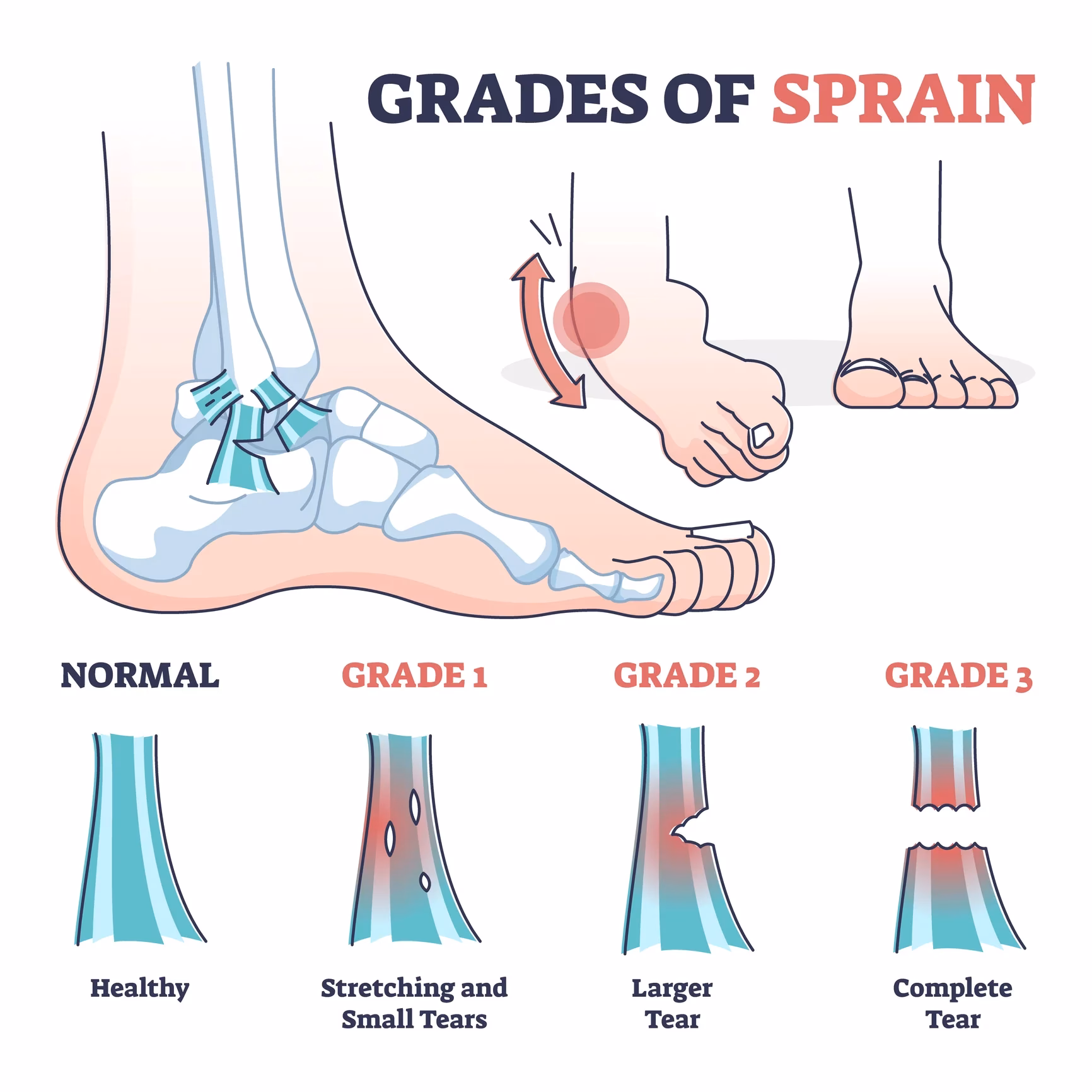 ¿Cómo se dice esguince o esguince de tobillo?
