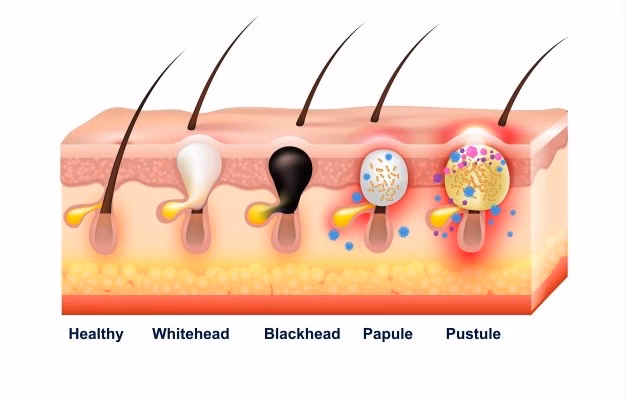 ¿Cómo quitar una espinilla enterrada en la entrepierna?