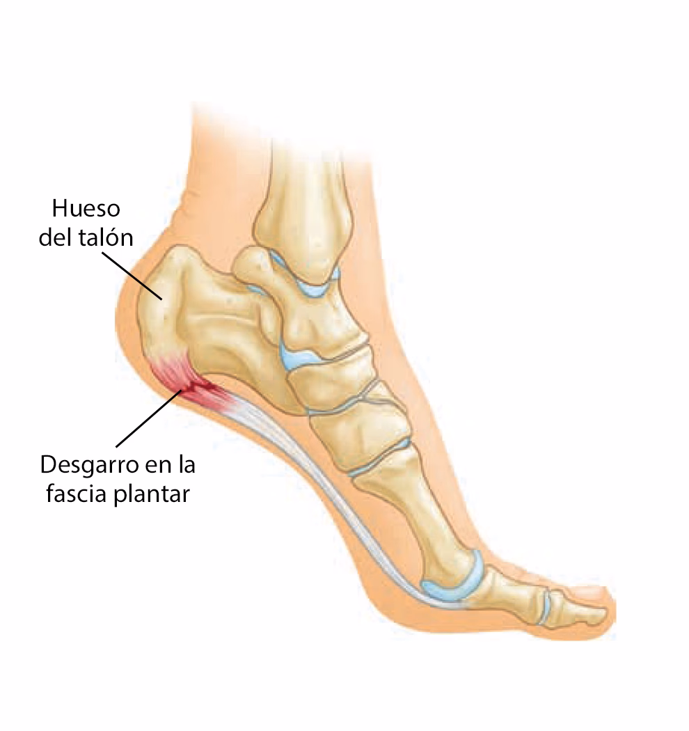 ¿Qué es un espolón en el pie?