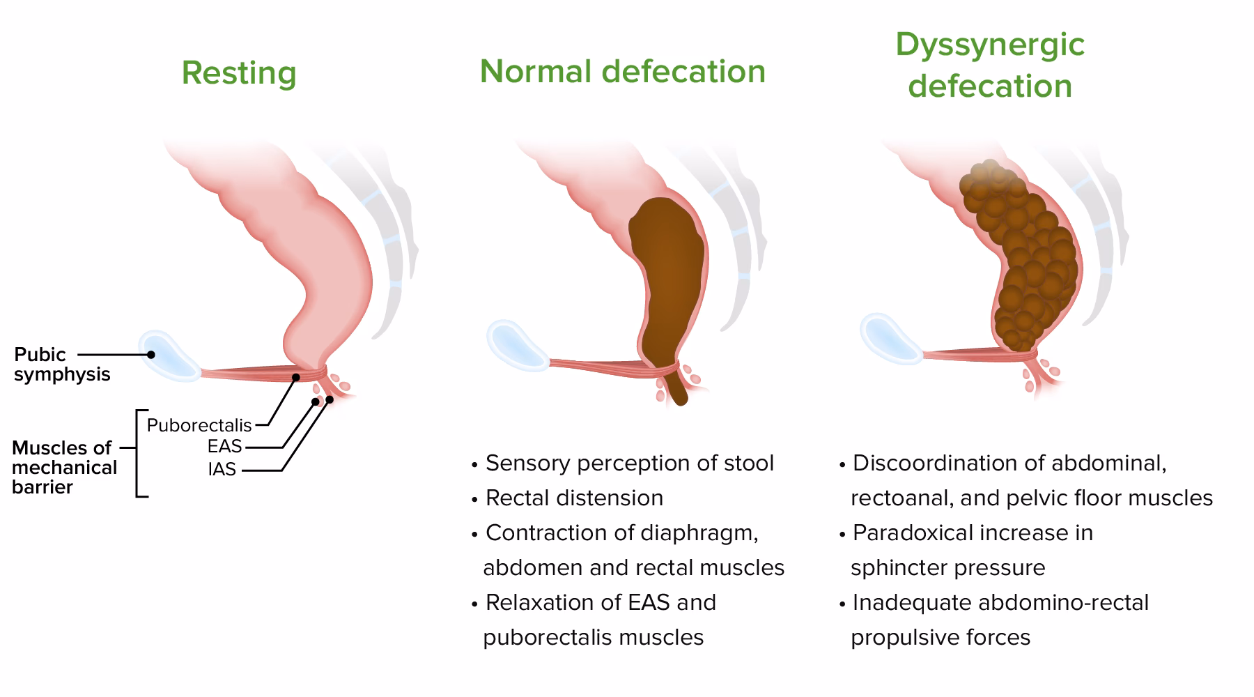 ¿Cuál es la diferencia entre estreñimiento y constipación?