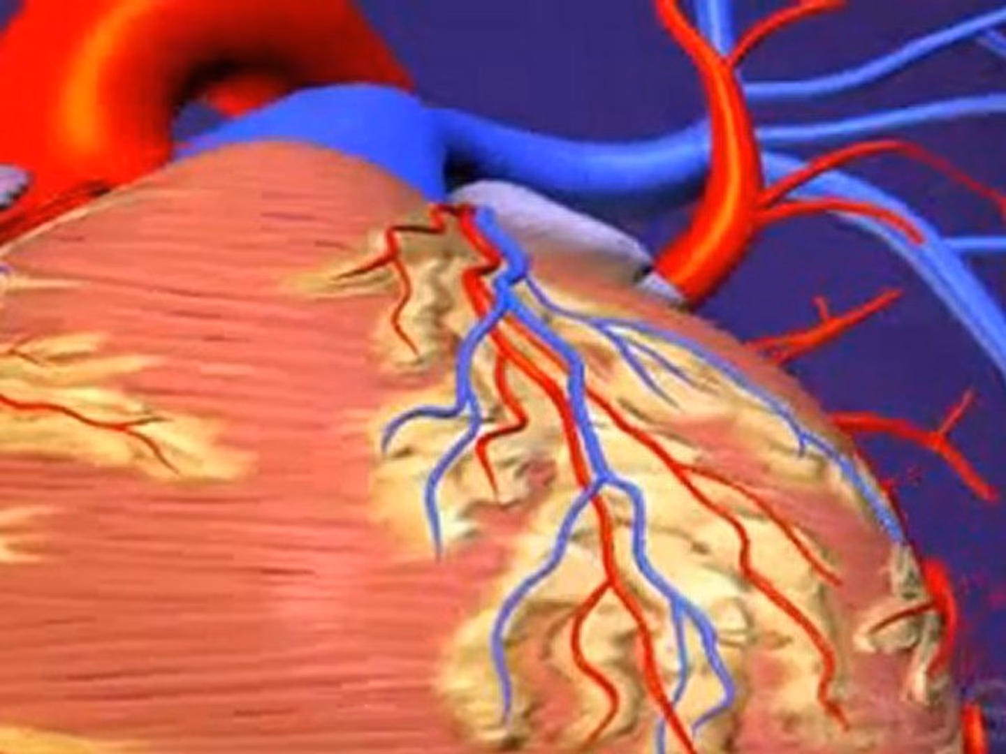 ¿Cómo se le dice al infarto?