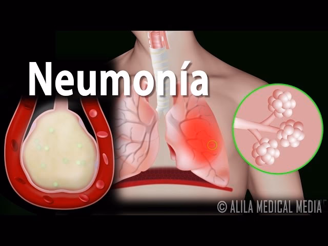 ¿Cómo se llama la neumonía en inglés?