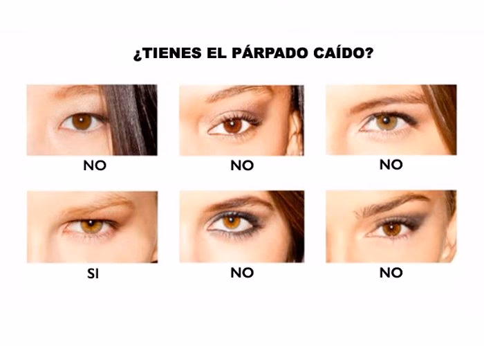 ¿Cómo se le dice al párpado caído?